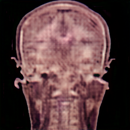 UNet coronal