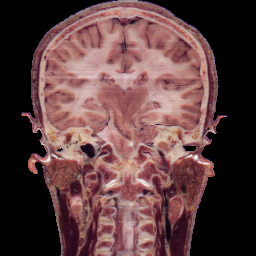 GT coronal