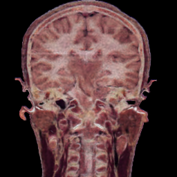 Ours coronal